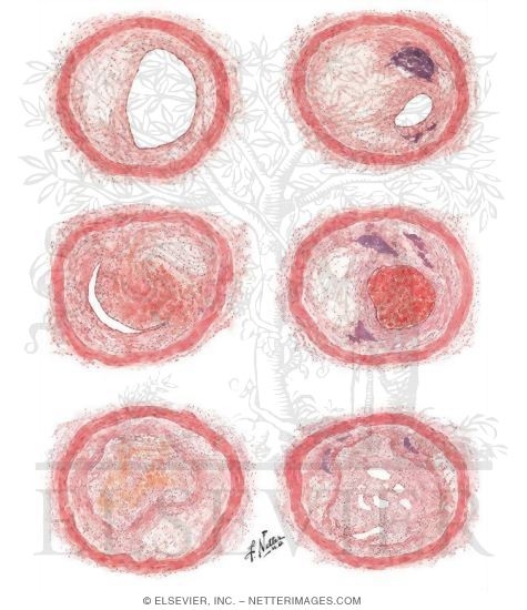 Pathologic Changes In Coronary Artery Disease
Types and Degrees of Coronary Atherosclerotic Narrowing Or Occlusion