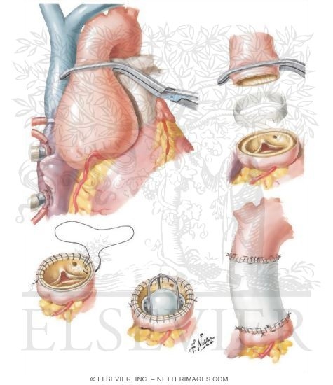 Watermarked preview of unlabeled image: Operation for Cystic Medial Necrosis