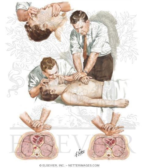Watermarked preview of unlabeled image: Cardiopulmonary Arrest and Treatment - External Resuscitation
