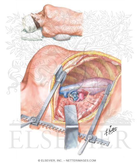 Watermarked preview of unlabeled image: Pneumonectomy (Right Lung)