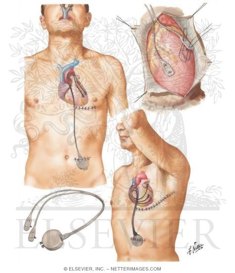 Pacemaker Implantation In Treatment of Complete Heart Block