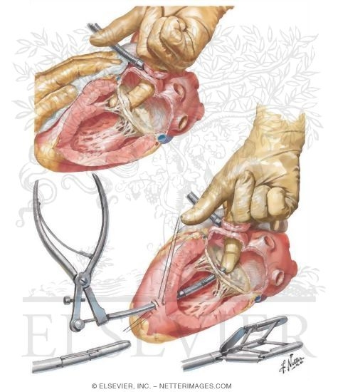 Closed Mitral Commissurotomy