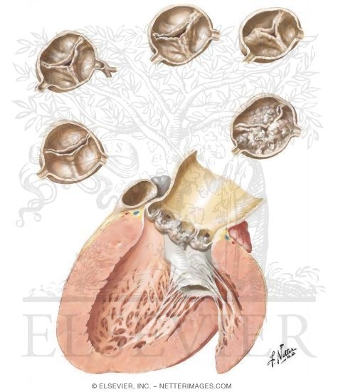 Watermarked preview of unlabeled image: Rheumatic Heart Disease X - Aortic Stenosis
Rheumatic and Nonrheumatic Causes of Aortic Stenosis