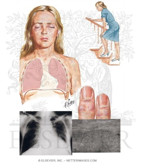 Watermarked preview of unlabeled image: Dermatomyositis and Polymyositis; Lung Involvement