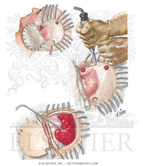 Operation for Parietal Epidural Hematoma
