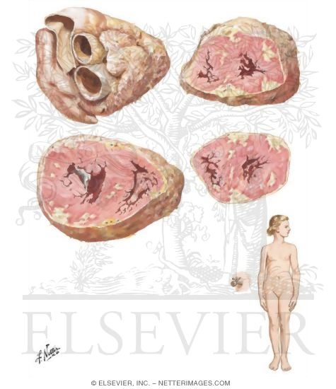 Watermarked preview of unlabeled image: Septic Myocarditis