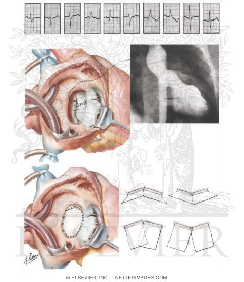 Endocardial - Cushion Defects