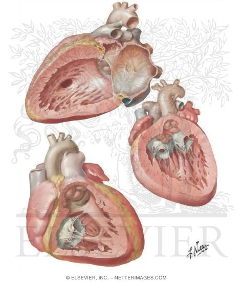 Watermarked preview of unlabeled image: Anomalies of the Ventricular Septum