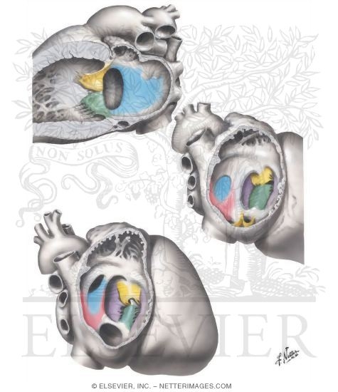 Endocardial - Cushion Defects