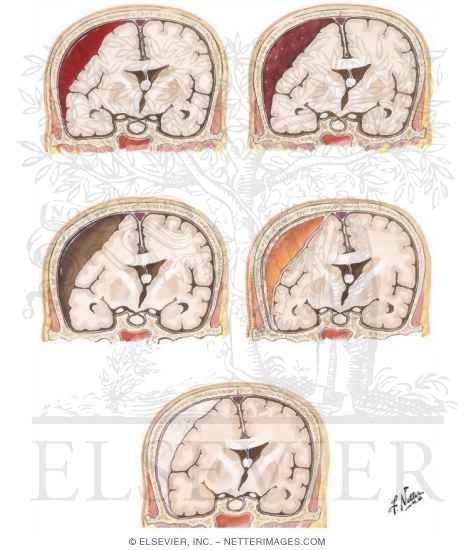 Watermarked preview of unlabeled image: Natural History of Nonlethal Subdural Hematoma