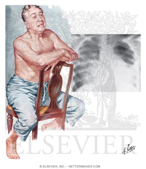 Watermarked preview of unlabeled image: Left Heart Failure and Pulmonary Congestion