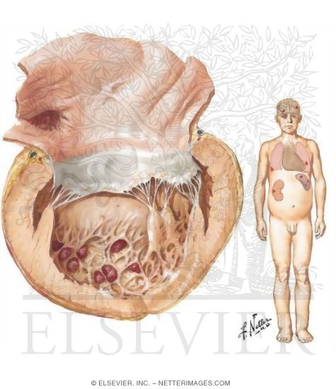 Watermarked preview of unlabeled image: Becker's Disease