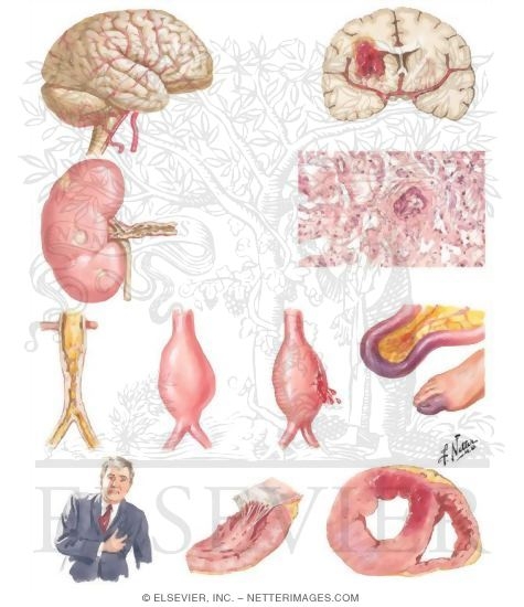 Watermarked preview of unlabeled image: Critical Areas of Atherosclerosis