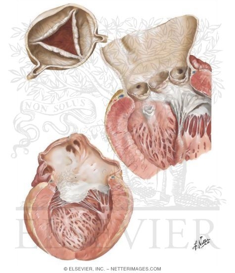 Watermarked preview of unlabeled image: Rheumatic Heart Disease XI - Aortic Insufficiency