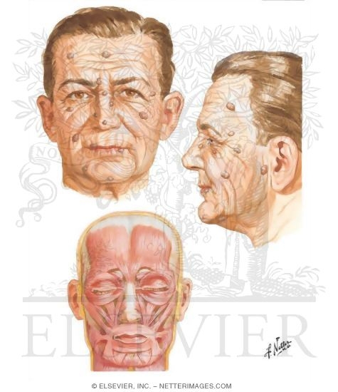 Lines of Incision for Removal of Skin Tumors of the Face