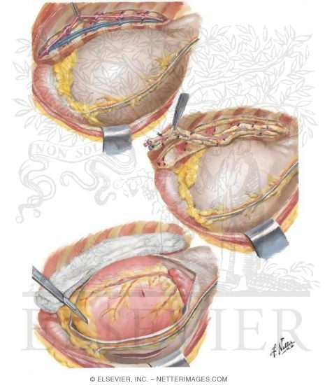 Watermarked preview of unlabeled image: Myocardial Revascularization by the Vineberg and the Sewell Technique