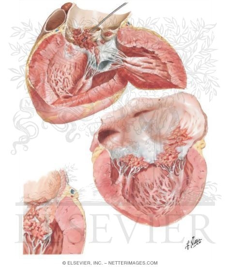 Watermarked preview of unlabeled image: Bacterial Endocarditis - Advanced Lesions
