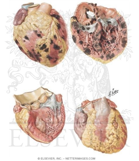 Watermarked preview of unlabeled image: Metastatic Heart Tumors