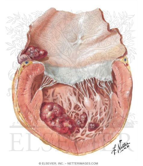 Watermarked preview of unlabeled image: Cardiac Myopathies