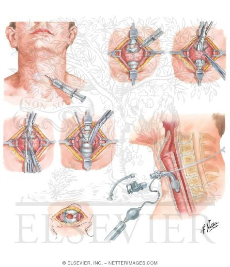 Tracheostomy