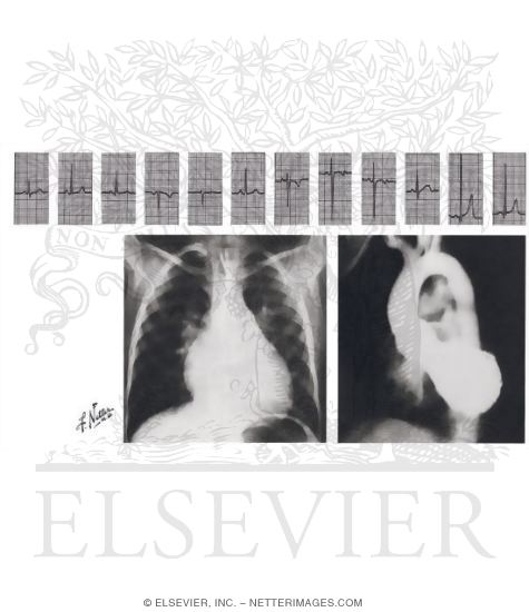 Watermarked preview of unlabeled image: Anomalies of the Ventricular Septum