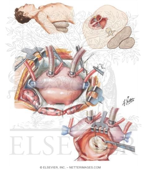 mitral valve replacement mitral valve replacement