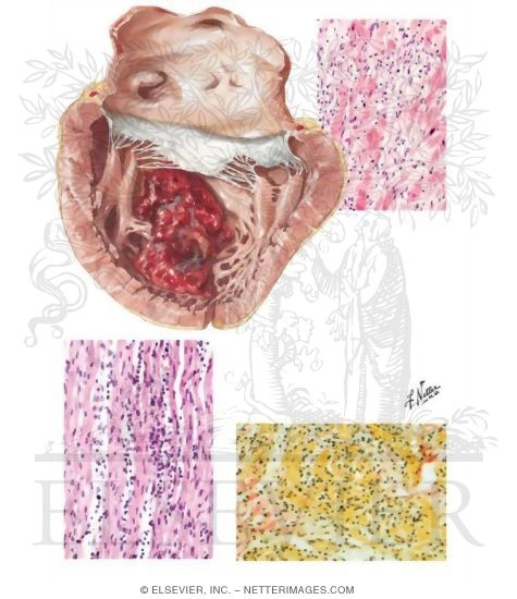 Diphtheritic and Viral Myocarditis