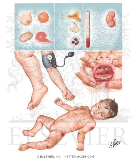 Vitamin C Deficiency (Scurvy)