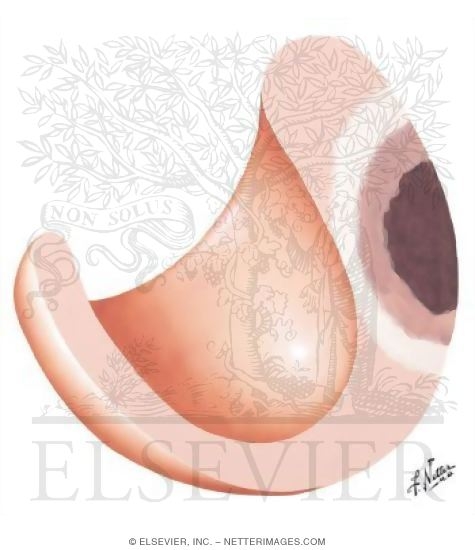 Effect of Cardiac Infarction, Injury, and Ischemia
Myocardial Ischemia, Injury, and Infarction