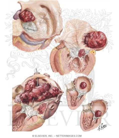 Watermarked preview of unlabeled image: Rheumatic Heart Disease VII - Mitral Stenosis: Thromboembolic Complications