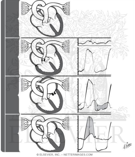 cardiac catheterization interpretation of findings cardiac catheterization interpretation of findings