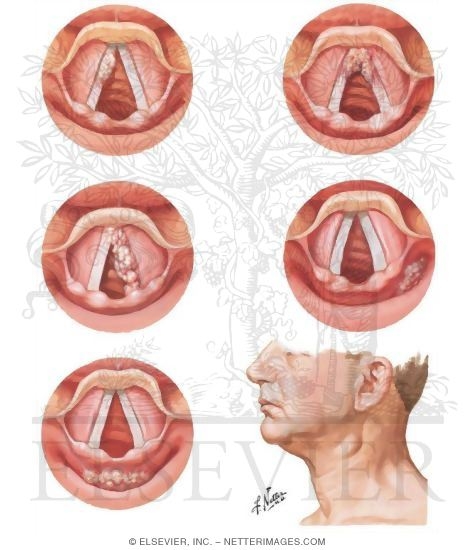 Cancer of the Larynx