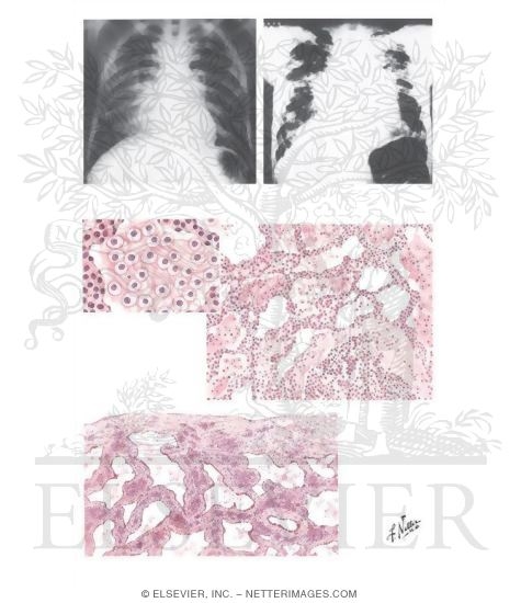 Watermarked preview of unlabeled image: Hypersensitivity Pneumonia