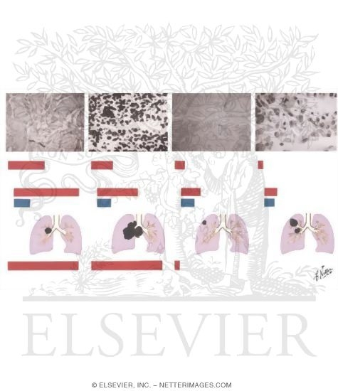 Watermarked preview of unlabeled image: Classification of Bronchogenic Carcinoma (@ 95% of All Lung Carcinoma)