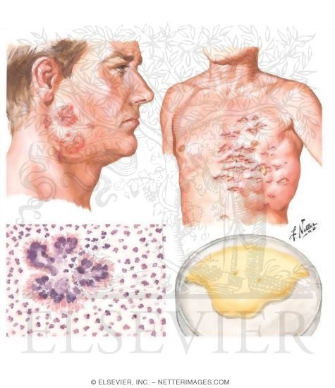 Actinomycosis