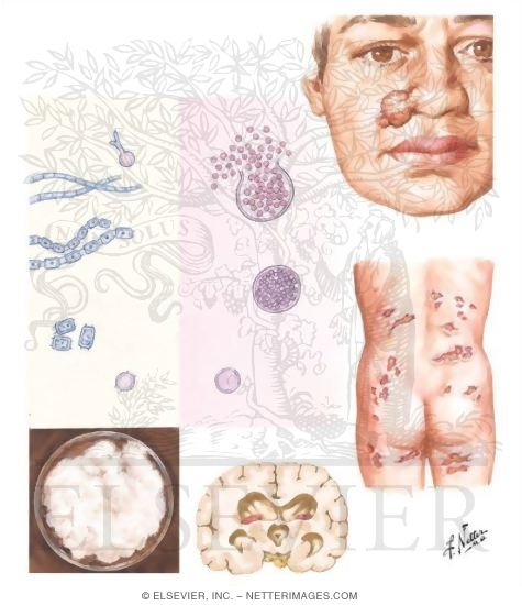 Coccidiodomycosis