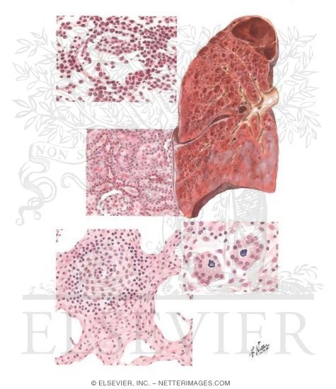 Watermarked preview of unlabeled image: Cadmium Inhalation Effects - Chronic Beryllium Disease