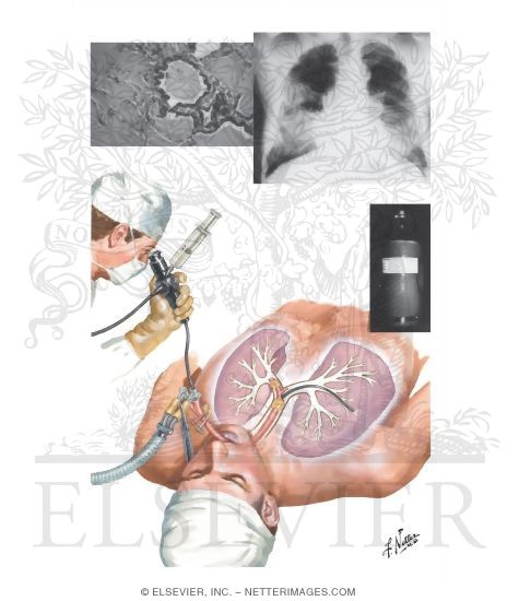 Watermarked preview of unlabeled image: Alveolar Proteinosis