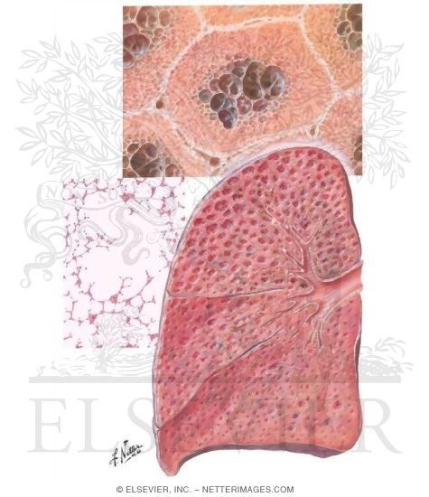 Centriacinar (Centrilobular) Emphysema