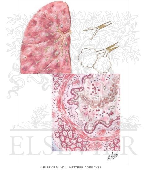 Pathology of Status Asthmaticus
Pathology of Asthma
