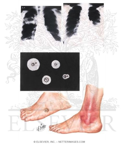 Watermarked preview of unlabeled image: Cryptococcosis (Torulosis)