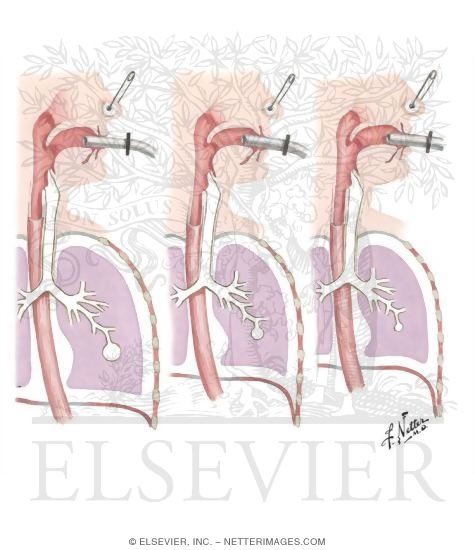 Measurement of Elastic Properties of Lung