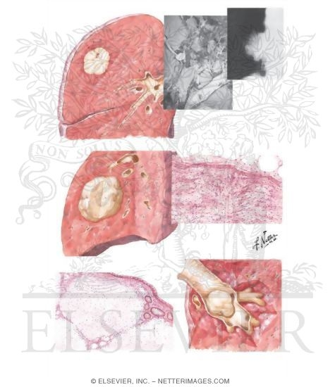 Benign Tumors of Lung