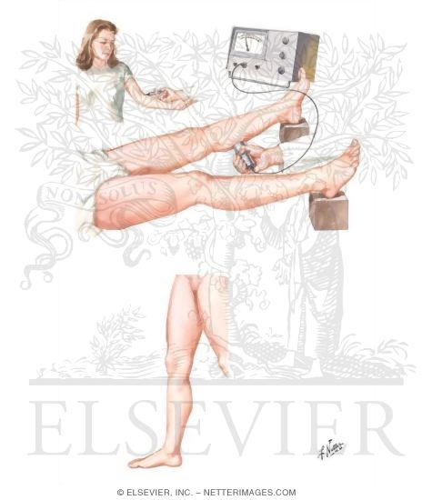 Radioactive Fibrinogen Scan for Diagnosis of Leg Vein Thrombosis