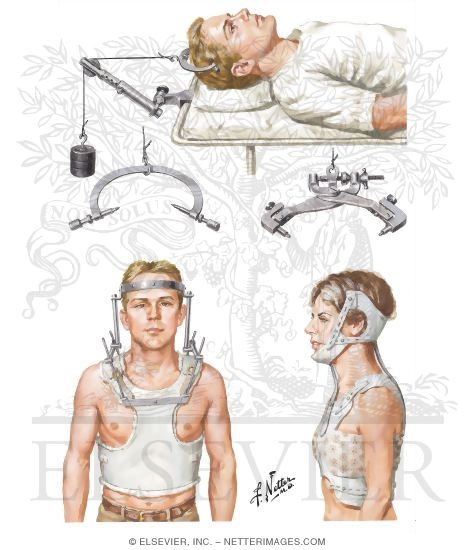 Watermarked preview of unlabeled image: Skull Traction; Bracing