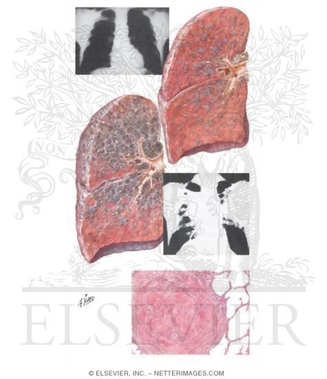 Silicosis