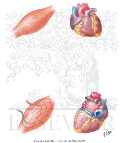 Watermarked preview of unlabeled image: Chronic Stable Angina