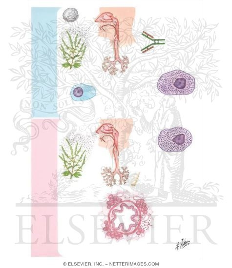 Watermarked preview of unlabeled image: Mechanism of Type 1 (Immediate) Hypersensitivity