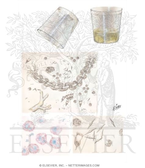 Watermarked preview of unlabeled image: The Sputum in Bronchial Asthma