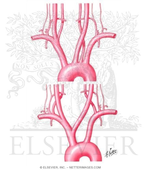 Watermarked preview of unlabeled image: Morphologic Variants of Vertebral and Common Carotid Arteries